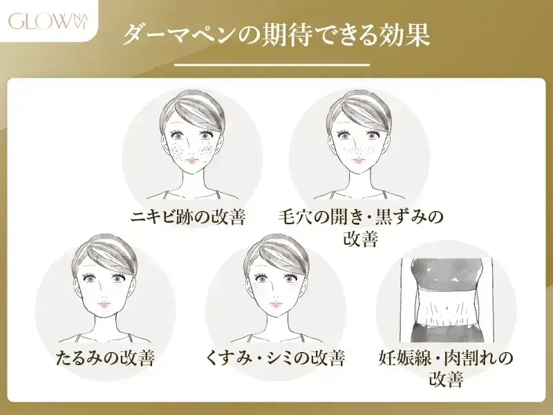 ダーマペン　効果